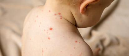 Chickenpox